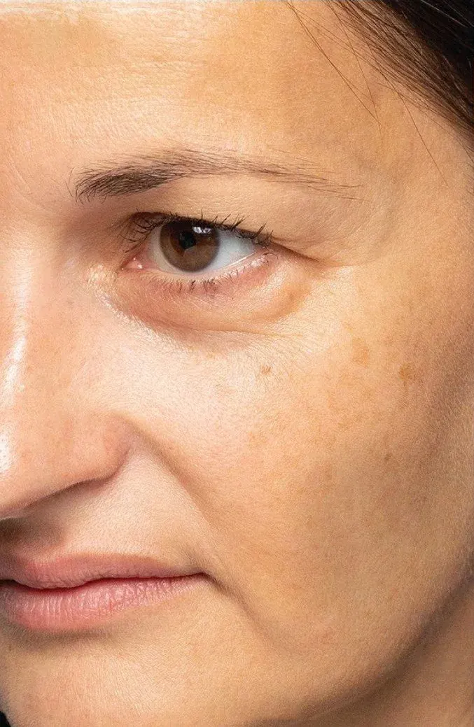 Fine lines around the eye