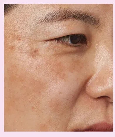 Dark spots and uneven skin tone