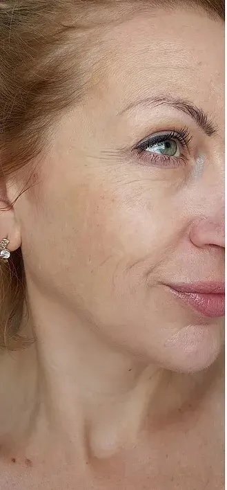 Facial fine lines and wrinkles